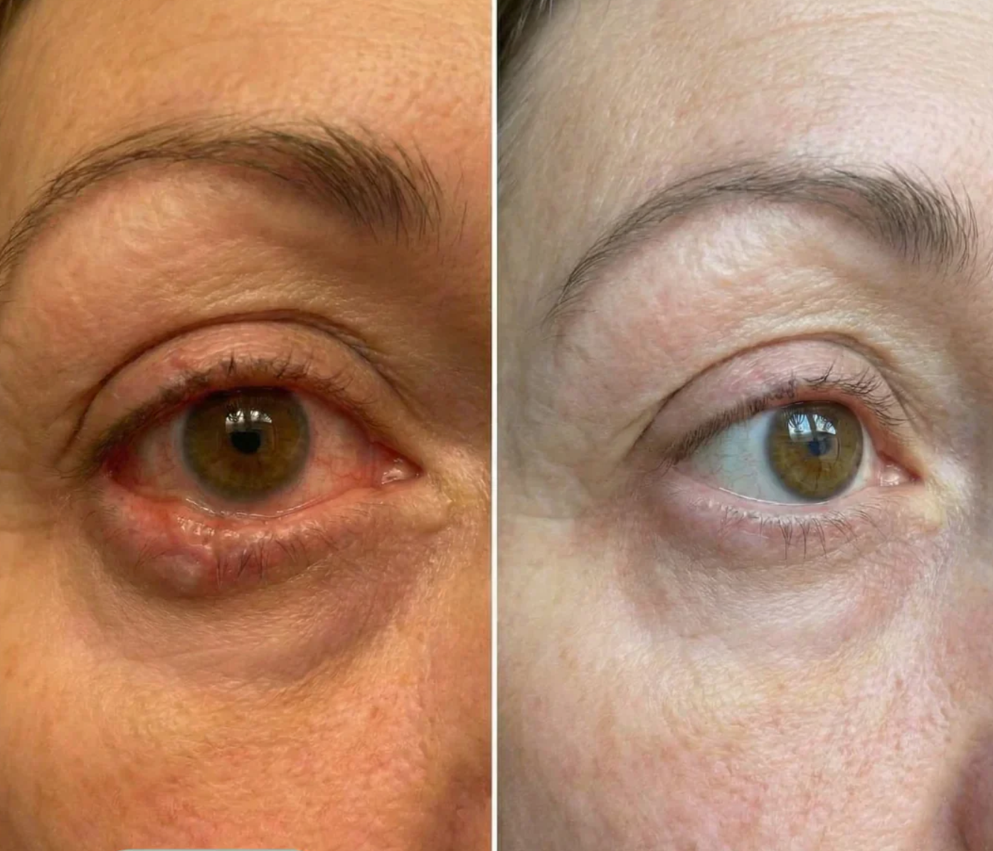 EyeRelief™ - Upplev friskare ögon utan ögondroppar